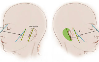 The rotation of the ear. The pinna has a polarity, or an axis of rotation. First, on the nonmicrotia side, the slope of the nose is drawn on the face, and the angle of the pinna is drawn, as determined by the longest measurement of the pinna. The angle between these is measured. On the microtia side, the slope of the nose is repeated, the angle is measured, and the axis of the reconstructed ear is drawn on the face. This becomes a guide for the planned rotation of the reconstructed ear.