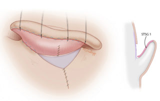The posterior surface of the construct is covered with skin graft and sutured to the sulcus, leaving a triangular defect on the mastoid that needs skin coverage.