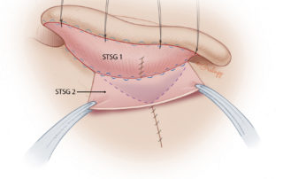 The excess skin is placed over the mastoid defect and secured with clamps before it is cut to shape and sutured in place (STSG 2).