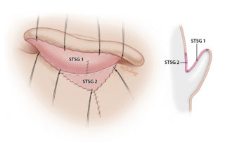 At the completion of stage 2, the ear is elevated, and the postauricular sulcus is created from two pieces of STSG. Bolster sutures are in place.