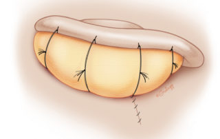 To adhere the skin grafts to the opposing surfaces, some surgeons use either a bolster or a mini-flap drain (e.g., 7 or 10 Fr). Bolsters or drains are left in for 4 days. The skin graft donor site along the scalp is often covered with a topical hemostatic dressing and nonocclusive gauze dressing.