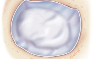 Placement of the temporalis fascia graft which is seated in broad contact with the malleus–incus complex to help prevent lateralization of the graft. The graft should extend on 1 to 2 mm up to the neocanal from the annulus, which encourages graft separation from the ossicles during healing due to lateralization of the newly formed tympanic membrane.