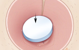 A 0.04-inch thick Silastic disk is trimmed to fit over the graft. This has several advantages: it avoids adherence of the fascia and skin graft to the packing material, encourages the adherence of the graft to the ossicles, and encourages formation of a right angle at the annulus level.