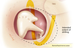 In atresia, the facial nerve may take an anomalous course. In one example, the second genu, which is usually a 90-degree bend, turns 180 degrees and exits the temporal bone via the glenoid fossa. When beginning atresia surgery, it is important not to mistake the glenoid for the ear canal, as deep dissection into the posterior aspect of the glenoid may injure the anomalous facial nerve.