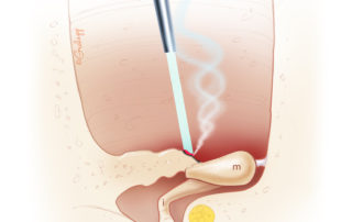 The thinned sheet of atretic bone overlying the ossicles may be removed more safely using a stapes curette rather than a drill. Soft tissue adherent to the ossicles may be vaporized with a laser.