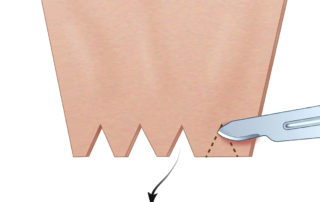 Split-thickness skin graft must be thin to engraft well on the bare bone. If too much dermis remains, it will swell and narrow the canal. Small triangles are removed to enable the graft to contour to the tympanic membrane graft without overlap. Trimming the skin graft is guided by measuring the depth of the newly formed canal and its circumference at both the level of the tympanic annulus and laterally at the bony opening. This can be done by placing a pliable ligature (e.g., silk) as a loop medially and laterally and then using a measuring stick to determine the desired size.
