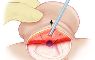Incisions to commence debulking postauricular soft tissues as part of the soft-tissue meatoplasty.