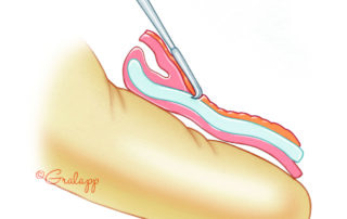 Schematic view of completed postauricular soft-tissue thinning.