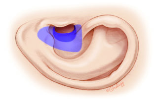 Creation of an adequately sized meatus is an essential component of chronic ear surgery. In canal wall down surgery, the size of the meatus needed depends on the size of the cavity. The meatus (dark blue) is matched to allow access to a small cavity (light blue).