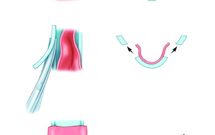 Postauricular Meatoplasty – Oto Surgery Atlas