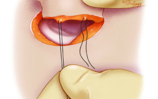Placement of the initial closure sutures is key to obtaining a proper shaped meatus. Placed through the deep tissue just lateral to the conchal cartilage excision, 2–0 sutures are placed at the upper and lower aspects of the meatus.