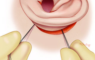 The sutures are anchored in the deep tissue at the back of the incision. Before tying, these are pulled taught to see how they affect the shape of the meatus. The goal is to drape the meatal skin over the trimmed edge of the conchal bowl. If draping is suboptimal, sometimes the skin incision needs to be extended.