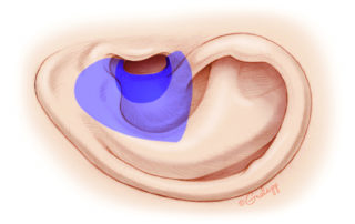 In canal wall down surgery, the size of the meatus needed depends on the size of the cavity. The meatus (dark blue) is matched to allow access to a large cavity (light blue).