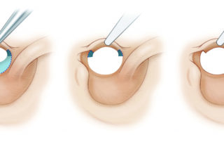 The meatoplasty procedure has two components: the posterior meatus (light blue) and the anterior meatus (dark blue).