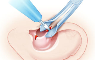 To reduce bleeding, electrocautery is used to deepen the incision. A nasal speculum can be used to spread apart the exposure.