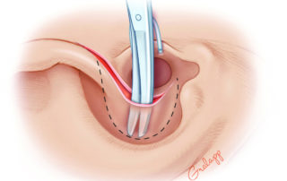 Elevation of conchal skin off conchal cartilage.