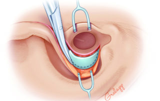 Excision of a rim of conchal cartilage.