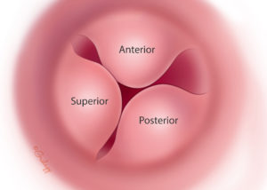 Exostoses of the ear canal are characteristically multiple. Surgery is indicated only when they are advanced and become obstructive or become stubbornly infected. Most surgeons prefer a postauricular approach, although a transcanal approach may be feasible with a large diameter canal.