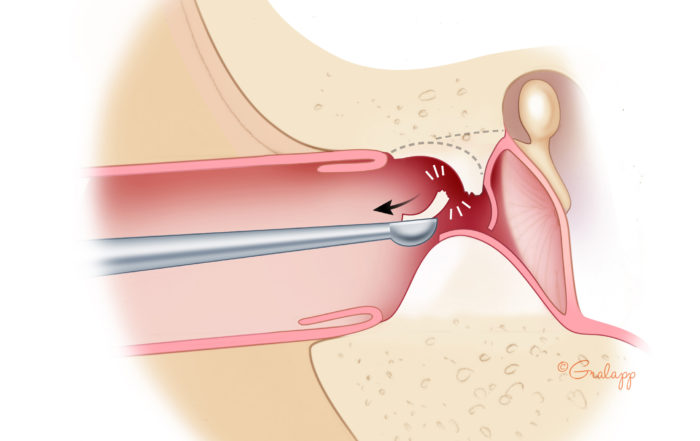 Exostoses of the Ear Canal – Oto Surgery Atlas
