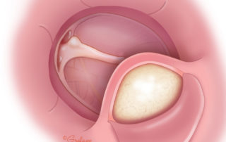 The inferior exostosis is removed last, only after a clear visualization of the posterior tympanic annulus is obtained for orientation.