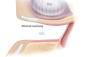 Anterior ear canal with minimal overhang.