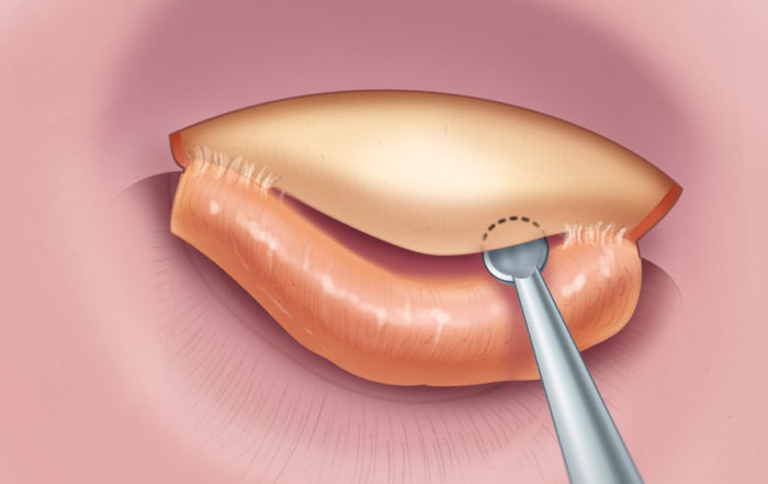 Anterior Canalplasty Oto Surgery Atlas