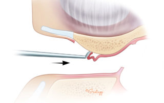 Elevation of canal skin flap.