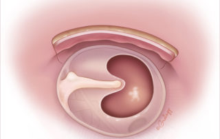 Replacement of the skin flap shows full visualization of the tympanic membrane.