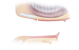 Replacement of the skin flap shows full visualization of the tympanic membrane.