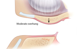 Anterior ear canal with moderate overhang. EAC, external auditory canal; TMJ, temporomandibular joint.