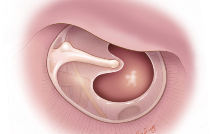 Anterior Canalplasty Oto Surgery Atlas