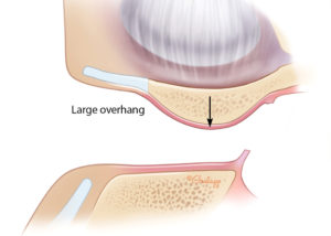 Anterior ear canal with major overhang obscuring the anterior portion of the tympanic membrane.