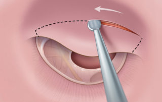 Anterior canal incision.