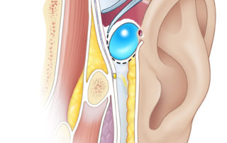In large preauricular cysts, especially those that have been infected numerous times, dissection of the cyst with a surrounding cuff of tissue off the temporalis fascia is the best strategy for achieving total removal.