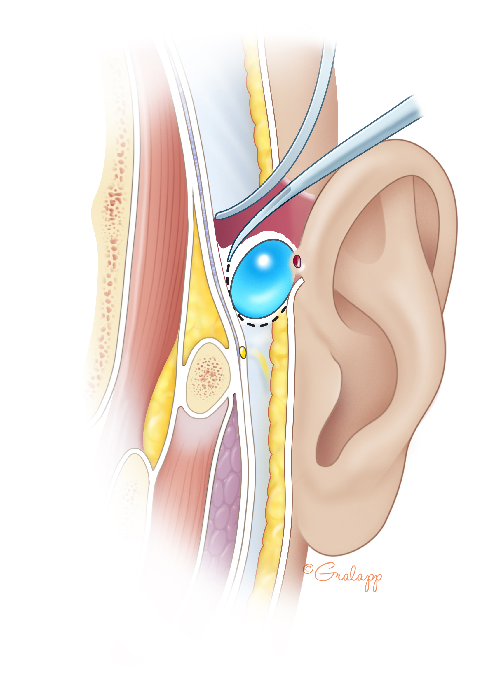 preauricular pit infection
