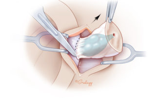 Following the surface of the cyst, its attachment to the helical crus is defined. To decrease the risk of recurrence, the cartilage in contact with the cyst should be excised and removed with the cyst. The surface of the cartilage is exposed peripherally around the cyst, allowing for an elliptical incision on the cartilage. While removing cartilage, it is important not to violate the skin of the cymba concha which underlies it.