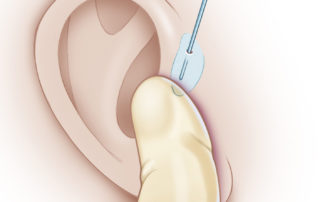 Some surgeons use a lacrimal probe and methylene blue dye to map out the extent of the cyst. The lacrimal probe is used first to gently dilate the opening to allow the introduction of methylene blue. If this is done aggressively, a false passage can be made, allowing the extravasation of methylene blue into normal tissues. Typically, lacrimal probes from size 0 up to no larger than size 1 are used. Methylene blue can often guide the dissection and allow reassurance of complete removal when the cyst is adequately dyed.