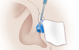 Methylene blue is injected with a 1-mL TB syringe via a 24-gauge Angiocath to allow for controlled introduction. The corner of an alcohol wipe can be kept at the opening to collect any excess methylene blue. Very little dye is often needed to stain the cyst, and a gentle tap of the syringe is recommended over a push.