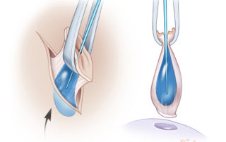 Once the ellipse has been cut and the cyst begins to be freed, the lacrimal probe can be reintroduced. The probe has dual purposes: to plug the pit to reduce extravasation of dye and also to palpate the extent of the cyst. A small Allis clamp secures the lacrimal probe while establishing traction while dissecting the cyst. Care must be taken to not rotate the Allis clamp along its axis as torsion may lead to a rupture of the cyst.