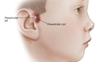 Preauricular cysts are prone to recurrent infections. When they have been repeatedly infected, especially when they have been incised and drained, considerable scarring to adjacent tissues as well as the overlying skin may be present.