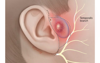 Excision of multiply infected, large preauricular cysts can present technical challenges. When the preauricular skin is abnormal due to recurrent infection and/or repeated drainage, the overlying skin should be removed together with the pit. In this situation, rather than try to follow the contours of the cyst, it is best to establish the plane on the temporalis fascia superiorly and dissect the infected cyst off the fascia en bloc with a cuff of surrounding scar tissue. The temporalis fascia, more specifically the superficial layer of the deep temporal fascia, continues inferior to the zygoma as parotid-masseteric fascia. So long as this fascial layer is not violated, the facial nerve is safe. Because the anterior margin of larger preauricular cysts may approach the temporal branch of the facial nerve, it is prudent to use electrophysiological monitoring. Closure of this wound is done with a face-lift technique. As the closure is often tight, undermining the facial skin may be needed to create the mobility to enable primary closure. Absolute hemostasis is required, especially as many branches from the superficial temporal artery are in this path.