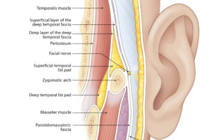 The temporalis fascia, more specifically the superficial layer of the deep temporal fascia, continues inferior to the zygoma as parotid-masseteric fascia. So long as this fascial layer is not violated, the facial nerve is safe.