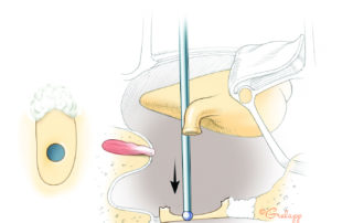 Creation of a small fenestra stapedotomy with a microdrill.