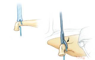 Positioning of the shepherd’s crook on the incus with a notched chisel (strut guide) and closing the wire with a crimper