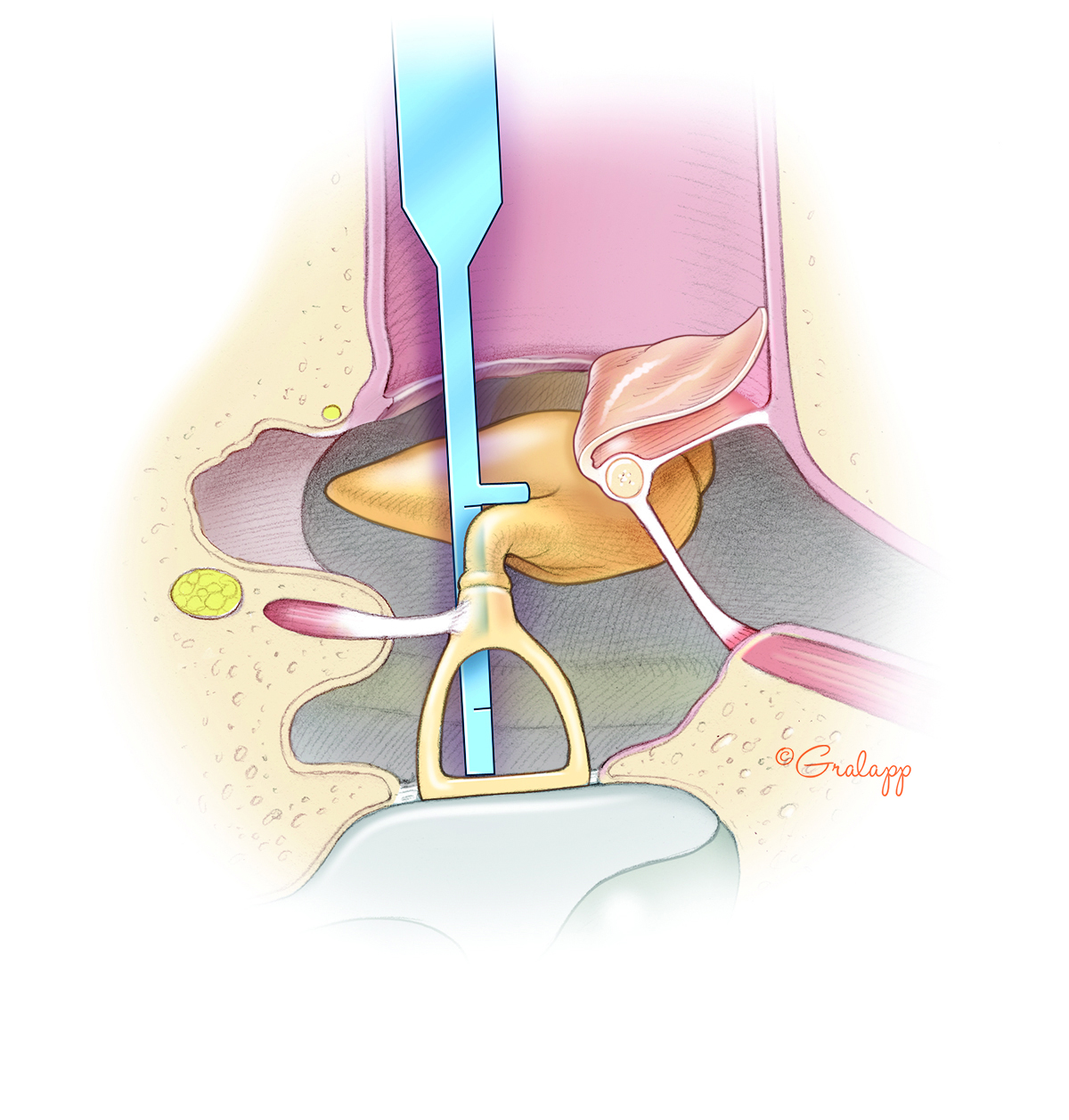 Tympanosclerosis – Oto Surgery Atlas