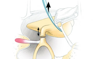 After division of the joint, mobility of the lateral ossicles (malleus and incus) is tested.