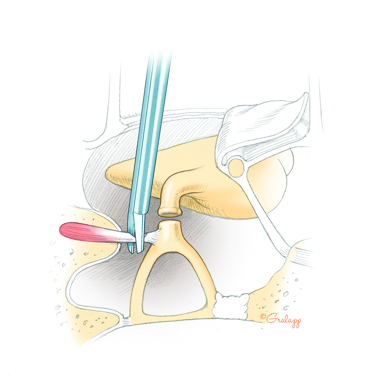 Tympanosclerosis – Oto Surgery Atlas