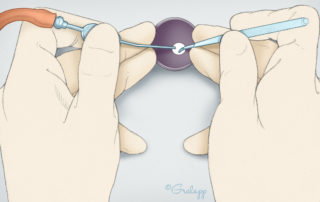 Placement of the surgeon’s hands during transcanal stapes microsurgery. The third and fourth fingers of each hand stabilize the speculum. Note that the microinstrument (right hand) and suction (left hand) are held in a manner to both optimize stability and to enable binocular viewing. Some surgeons use a speculum holder to enhance stability.