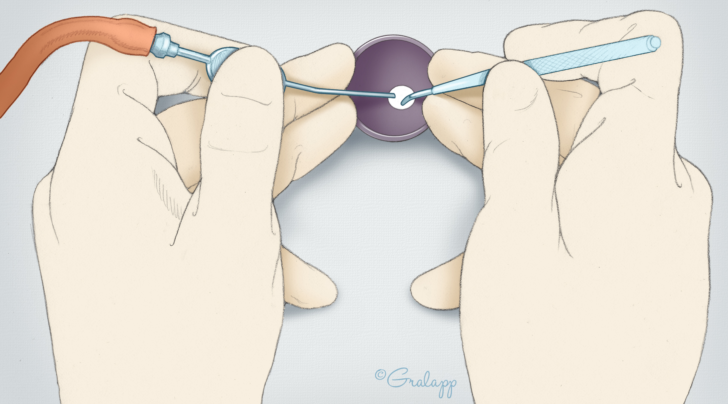 Tympanosclerosis – Oto Surgery Atlas