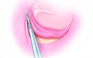 Cutting the vascular strip with scissors squeezes vessels closed and thereby reduces bleeding. It also creates a neatly designed flap without irregular edges. Some surgeons prefer to cut the entire flap with a stapes knife.
